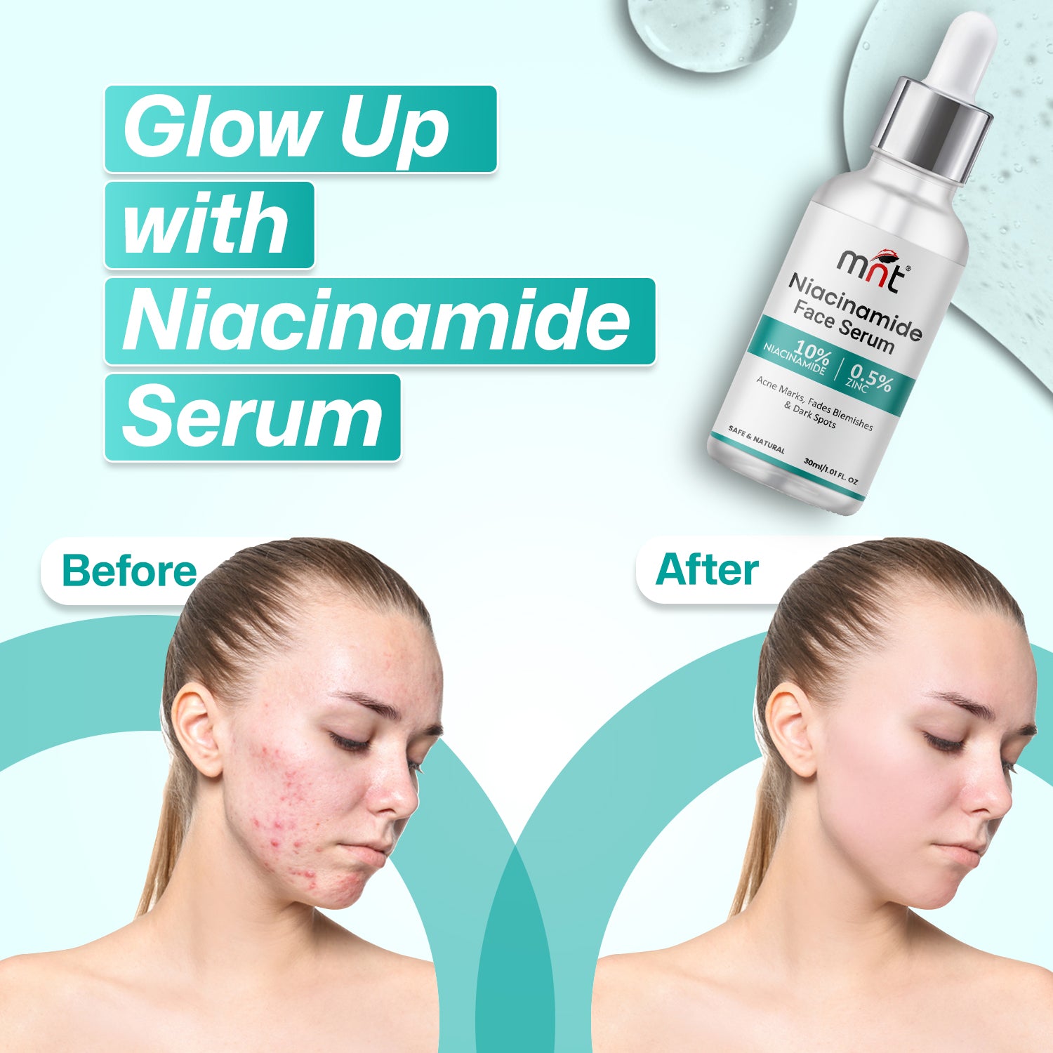 10% Niacinamide Face Serum with 0.5% Zinc for Acne Marks & Blemishes, 30 ml